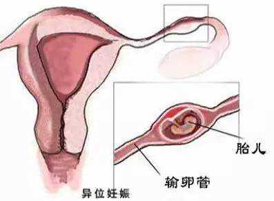 广州试管助孕方式，第五节广州