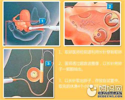 45岁卵巢早衰,卵巢早衰无卵可用45岁如何做试管婴儿