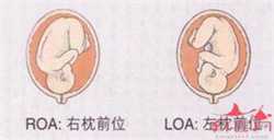 广州借卵试管费用高吗，3个步骤可助你预防早产(2)