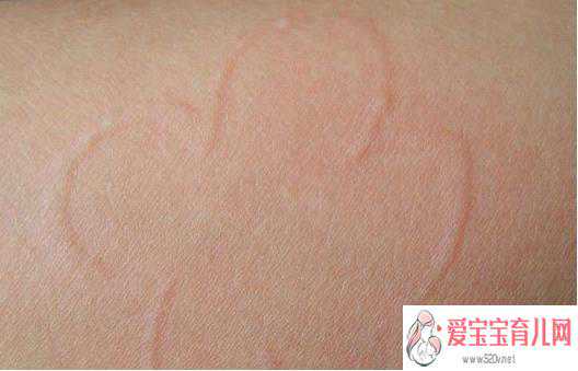 广州代怀中心，皮肤痒很有可能是荨麻疹！！荨麻疹会遗传吗？